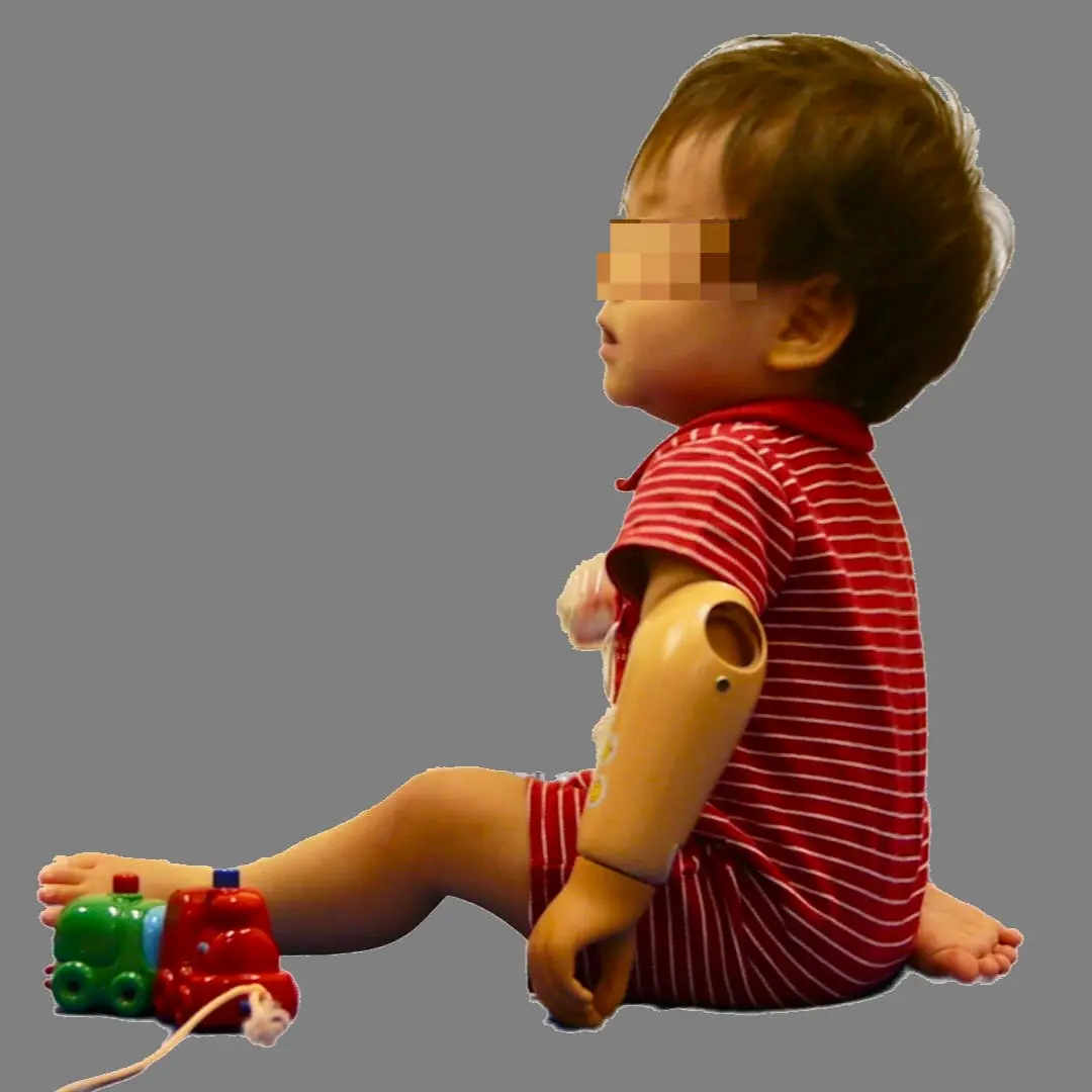 受動義手 子ども2